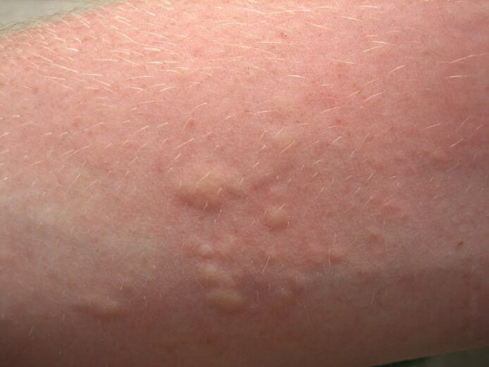 swędzące alergiczne wysypki skórne mogą być objawami glistnicy