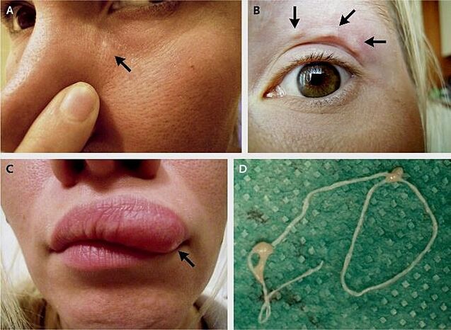 Główne objawy dirofilariozy na twarzy